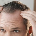 Minoxidil: El medicamento que está ganando en silencio la lucha contra la calvicie de miles de hombres y mujeres